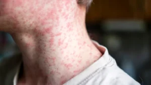 North Texas healthcare providers on high alert for measles