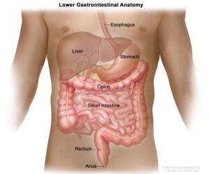 Colon cancer