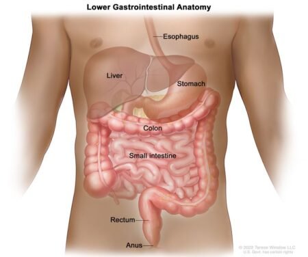 Colon cancer