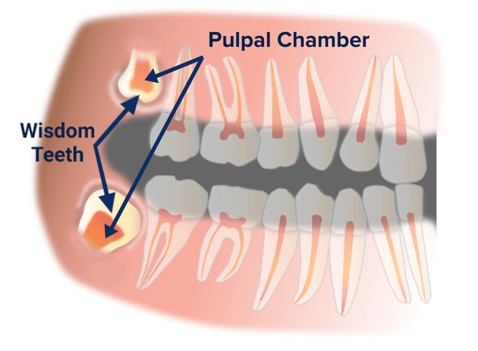 wisdom teeth stem cells