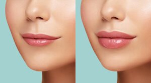 Thinking About Dissolving Lip Filler? What to Know