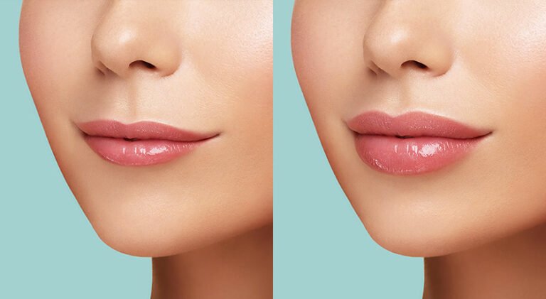 Thinking About Dissolving Lip Filler? What to Know